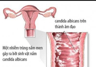 Công dụng men vi sinh giảm nhiễm trùng nấm men